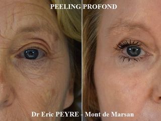 Avant après blépharoplastie