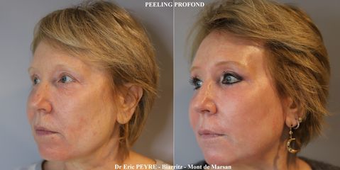 Peeling - Dr Eric Peyre