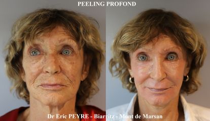 Peeling Profond - Dr Eric Peyre