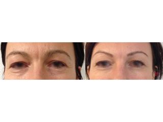 Botox - Dr Romain Tourniaire