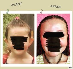 Otoplastie - Dr Romain Tourniaire