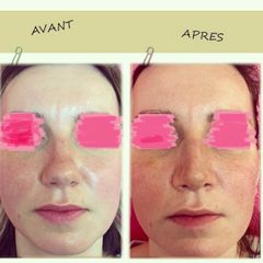 Rhinoplastie - Dr Romain Tourniaire