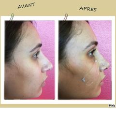 Rhinoplastie - Dr Romain Tourniaire