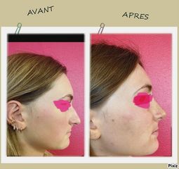 Rhinoplastie - Dr Romain Tourniaire