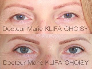Avant après blépharoplastie