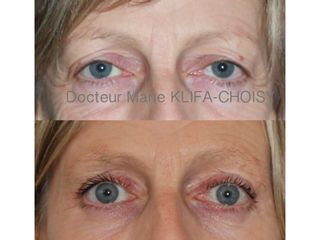 Avant après blepharoplastie