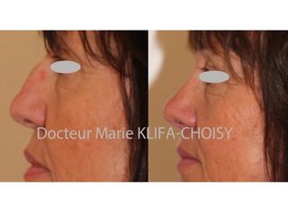 Avant après rhinoplastie