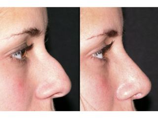 Avant après Rhinoplastie