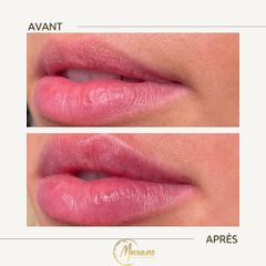 Augmentation des lèvres - Centre Laser Murano - Épilation & Médecine Esthétique