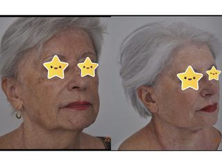 Fils tenseurs - Dr Fabienne Herault Bardin