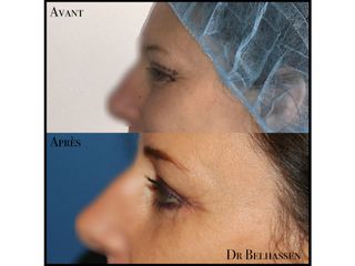 Avant après blepharoplastie