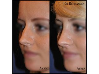 Avant après rhinoplastie