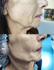 Fils tenseurs - Dr Catherine Dropsy