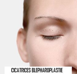 Blépharoplastie