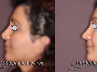 Avant après rhinoplastie