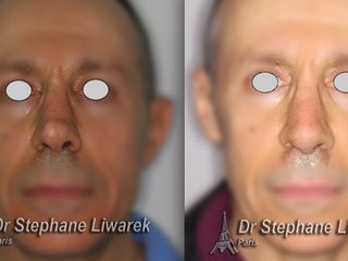 Avant après rhinoplastie