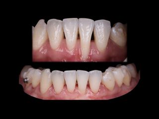 Greffe de gencive - Dr Ramzi Redissi