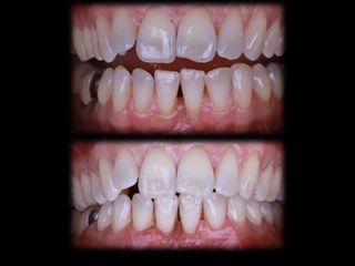 Greffe de gencive - Dr Ramzi Redissi