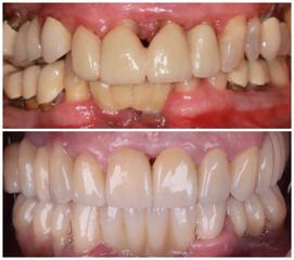 Implants dentaires - Dr Ramzi Redissi