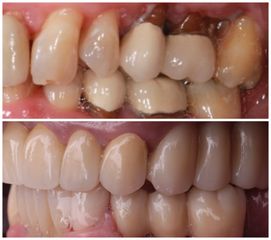 Implants dentaires - Dr Ramzi Redissi
