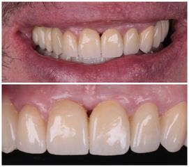Implants dentaires - Dr Ramzi Redissi