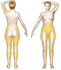Liposuccion