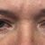 Blepharoplastie mon amie!