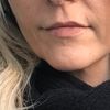 Quel âge pour un lifting ?