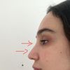 Rhinoplastie de la pointe du nez