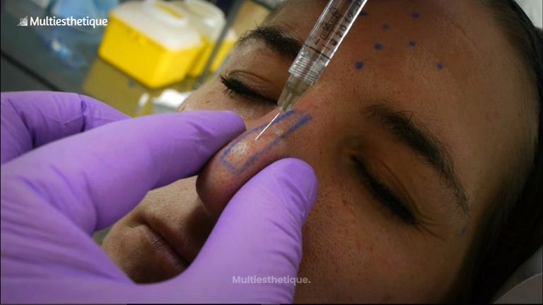 La rhinoplastie médicale