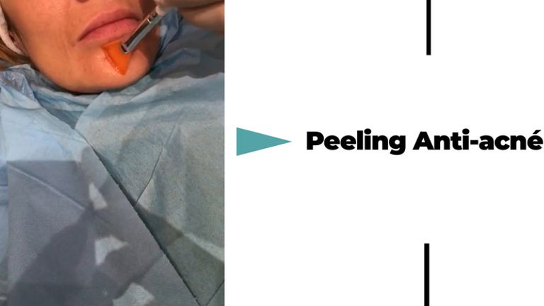 Peeling anti-acné - Dr Catherine De Goursac