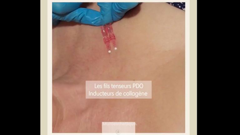 Fils tenseurs - Dr Marie Levisse - méDiKal esthétique