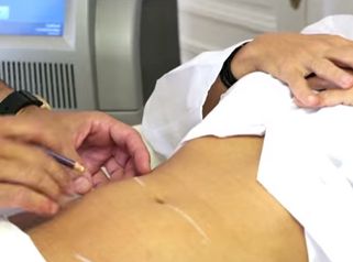 La cryolipolyse, un acte indolore et sécuritaire