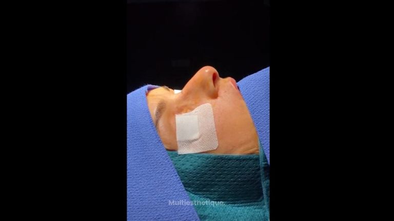 Rhinoplastie - Dr Pierre-Manuel Renard