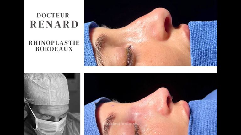 Rhinoplastie - Dr Pierre-Manuel Renard
